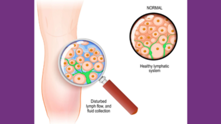 Lymphoedema V2.png