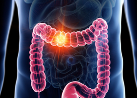 Colorectal _ Bowel Cancer.png