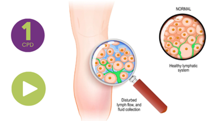 Lymphoedema Webinar Recording