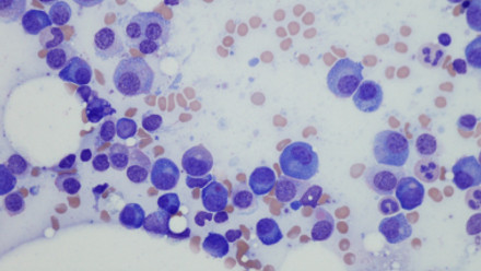 Myeloma.png