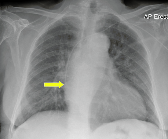 Good tip position_Marked.PNG