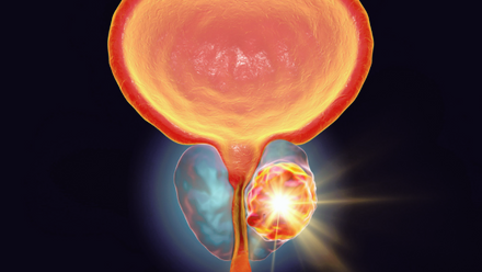 Prostate Cancer.png
