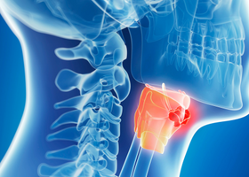 Head and Neck Cancer.png