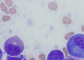 Innovation in Tele-Oncology in the Management of Multiple Myeloma.png